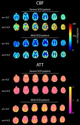 Impairment of Cerebrovascular Hemodynamics in Patients With Severe and Milder Forms of Sickle Cell Disease